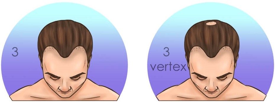 norwood 3 and 3-vertex hair loss 2500 grafts candidate