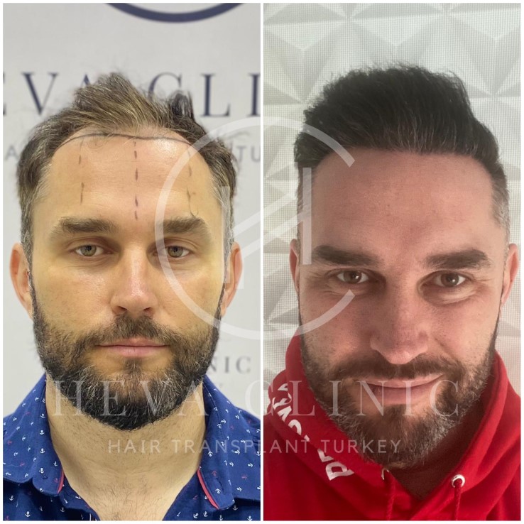 2800 grafts before and after hair transplant at heva clinic