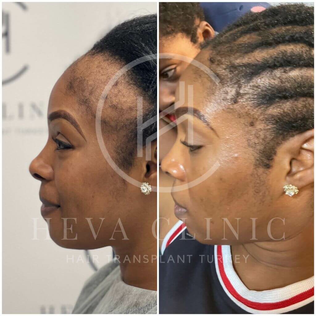 3000 grafts female hair transplant before and after result