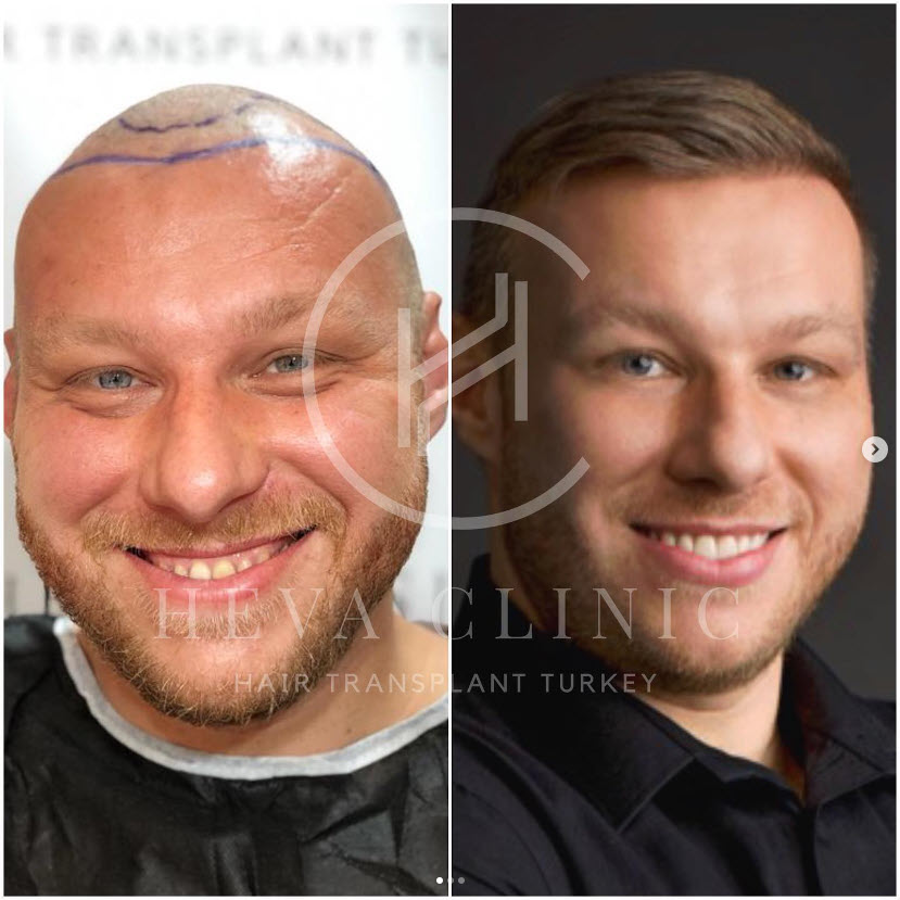 3000 grafts norwood 3 hair transplant before and after