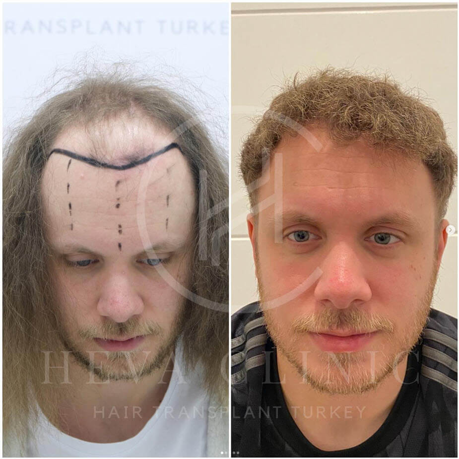 5000 grafts blonde hair transplant before and after