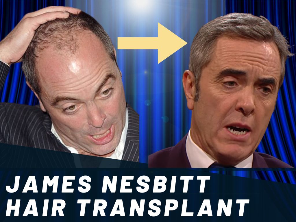James Nesbitt Hair Transplant Analysis Banner