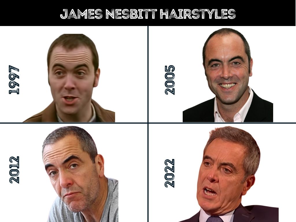 James Nesbitt before and after hair transplant photos