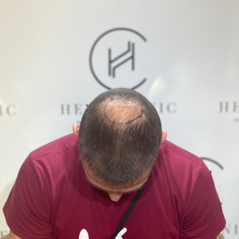 crown hair transplant candidate 1500 grafts heva clinic istanbul