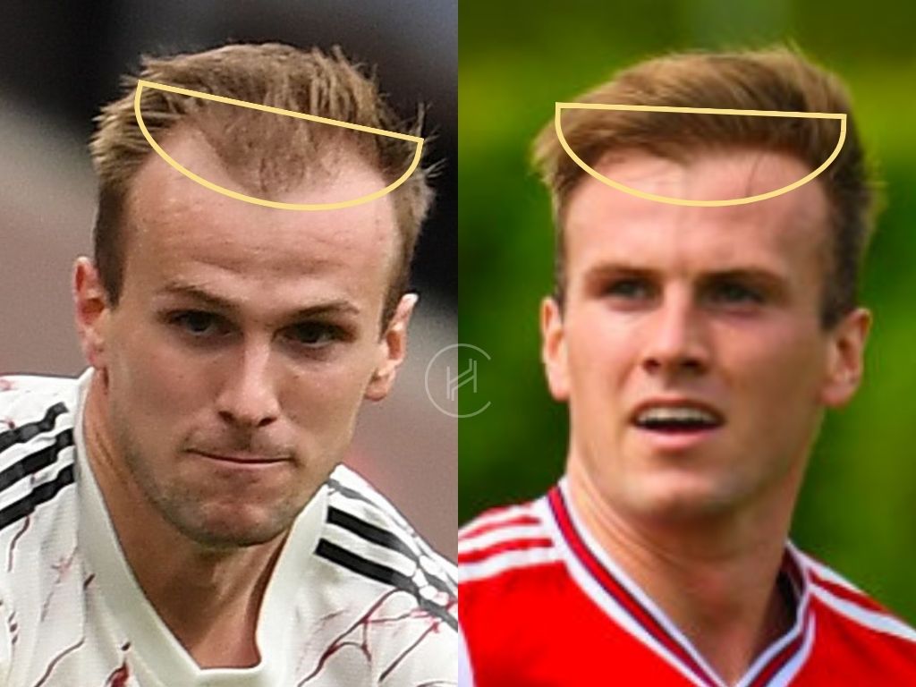 hair transplant before and after rob holding