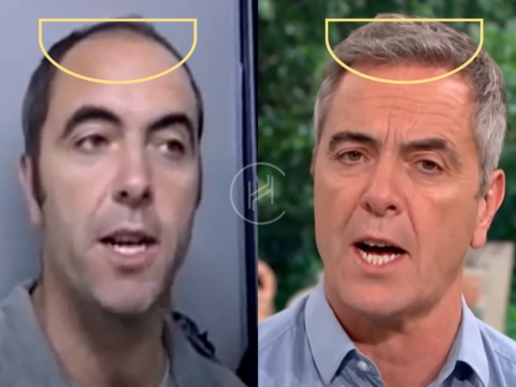 james nesbitt before & after hair transplant