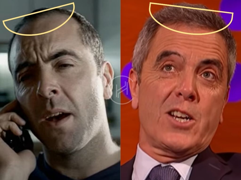 james nesbitt before and after hair transplant procedure