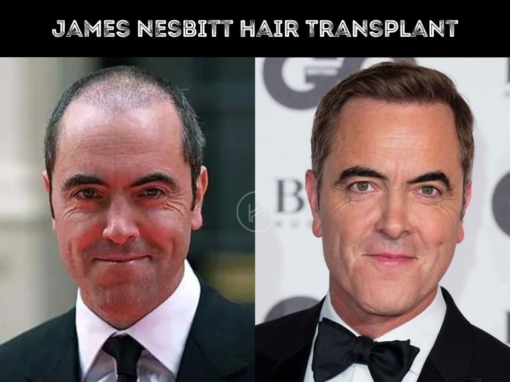 james nesbitt before and after hair transplant results