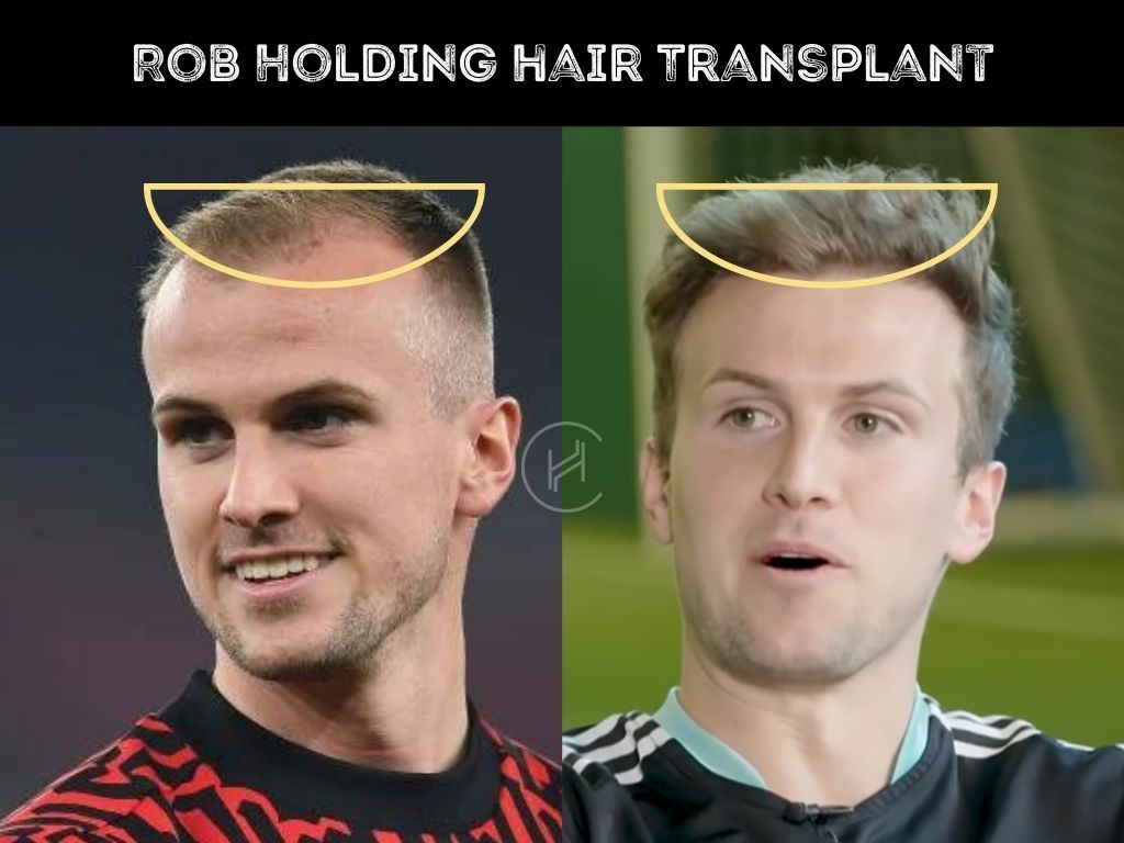 rob holding before & after hair transplant hairline