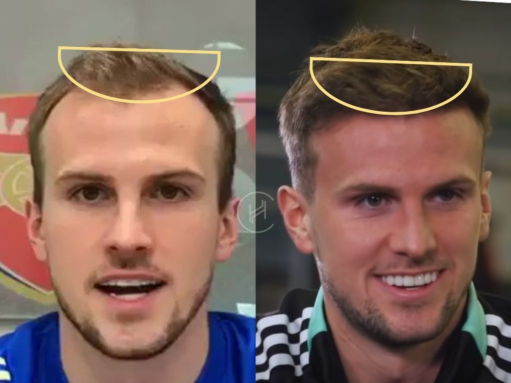 rob holding before and after hair transplant