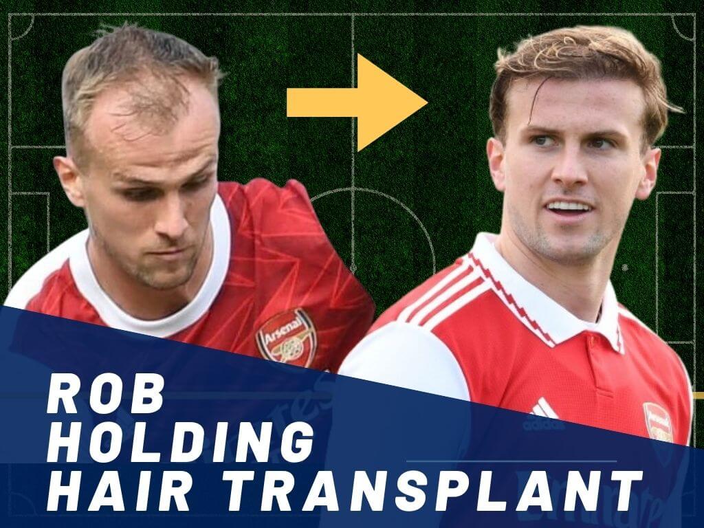 rob holding hair transplant techniacal analysis