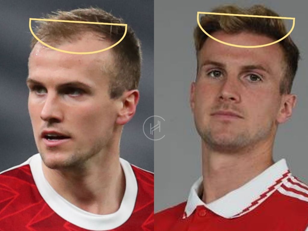 rob holding hair transplant before and after