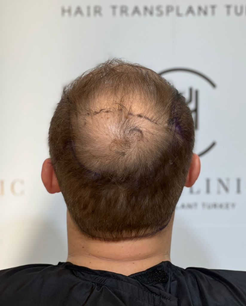 Crown Area Hair Transplant - Vertex Operation and Costs in 2023