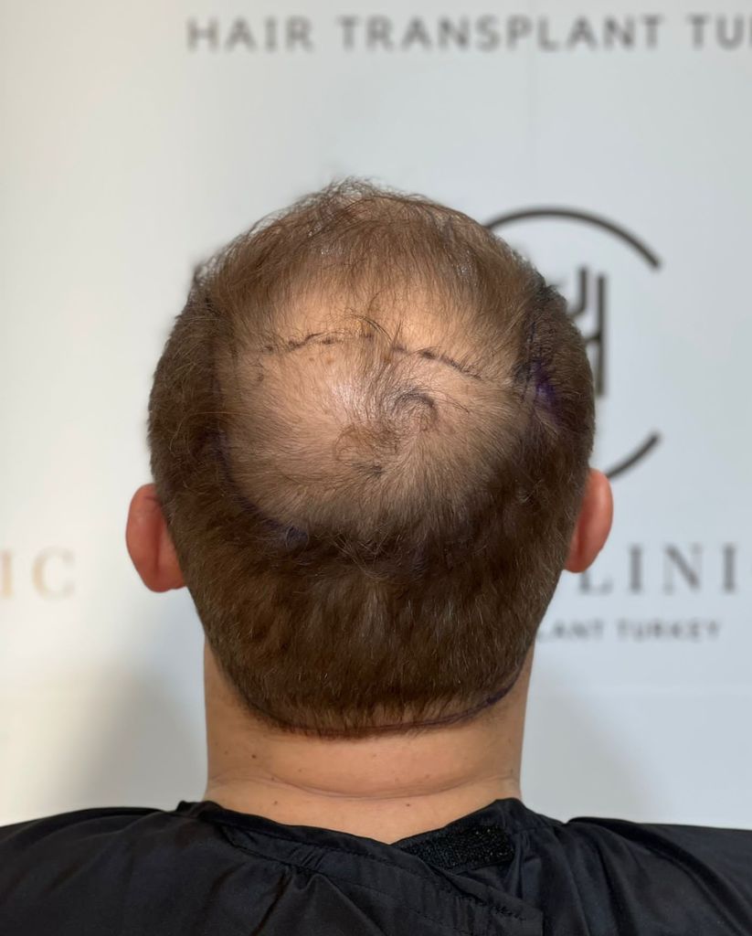 Crown Area Hair Transplant - Vertex Operation and Costs in 2023 Crown Area Hair Transplant - Vertex Operation and Costs in 2023
