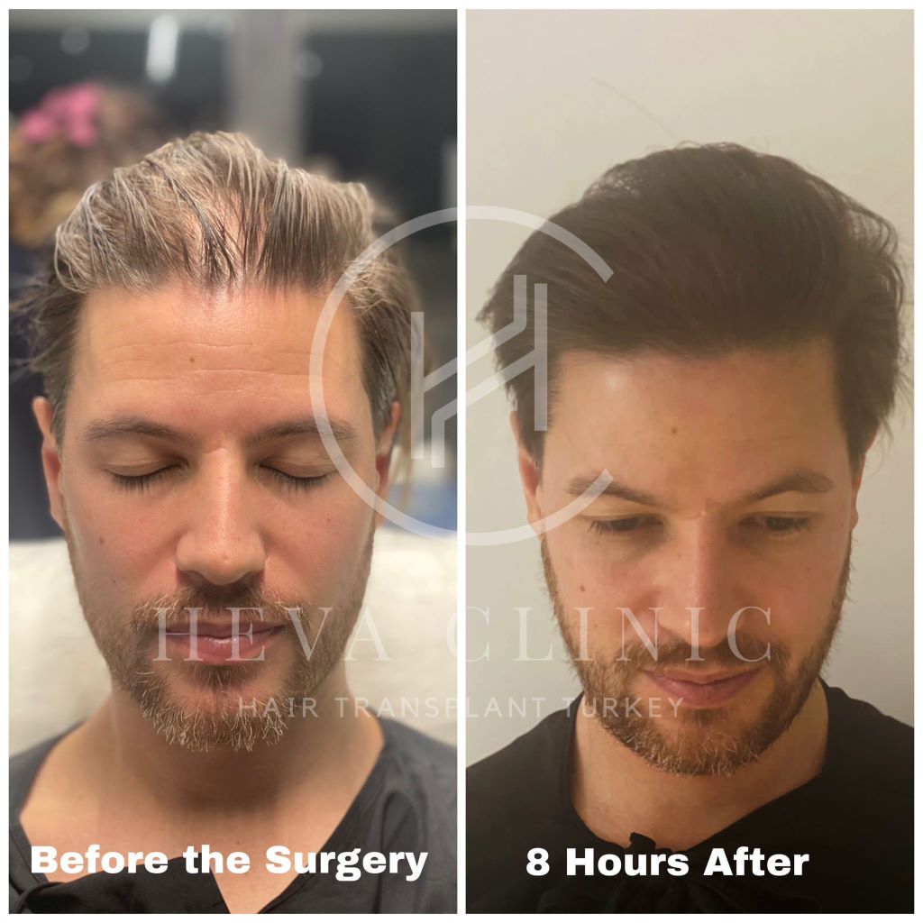Completely unshaven hair transplant frontline before and 8 hours after