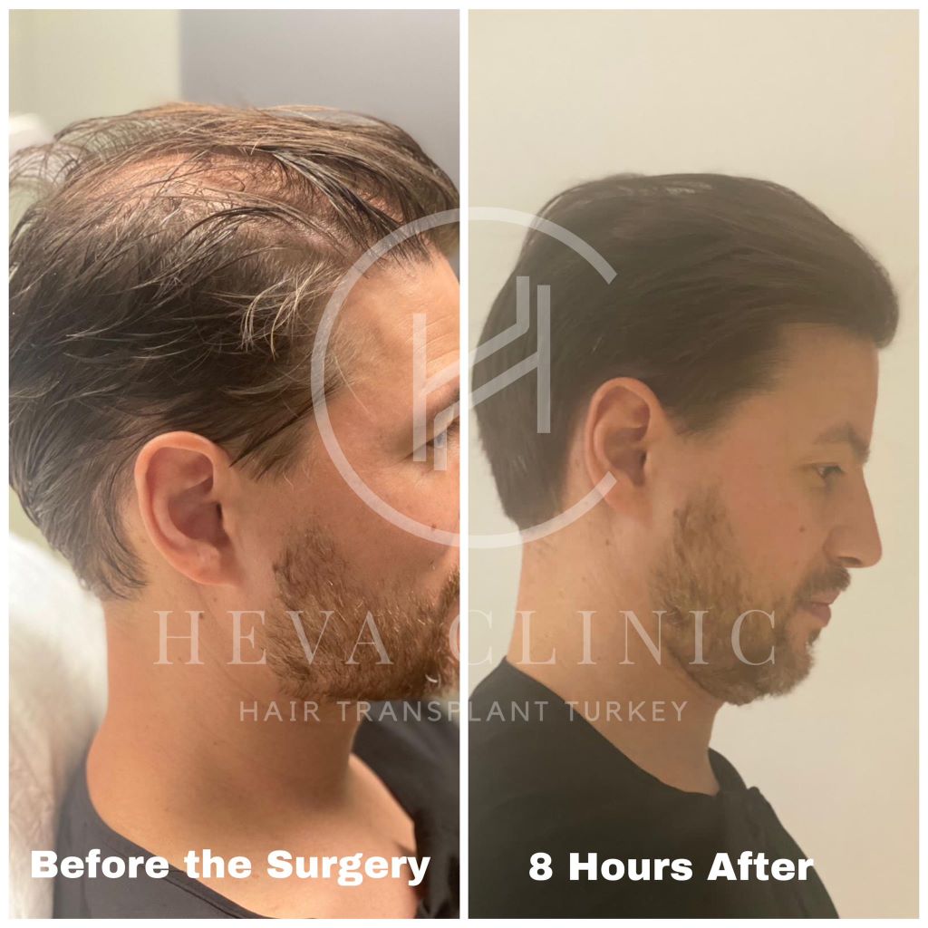 Completely unshaven hair transplant side before and 8 hours after