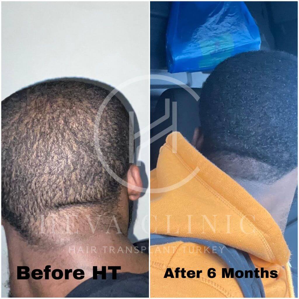Donor area 6 months after hair transplant Donor area 6 months after hair transplant
