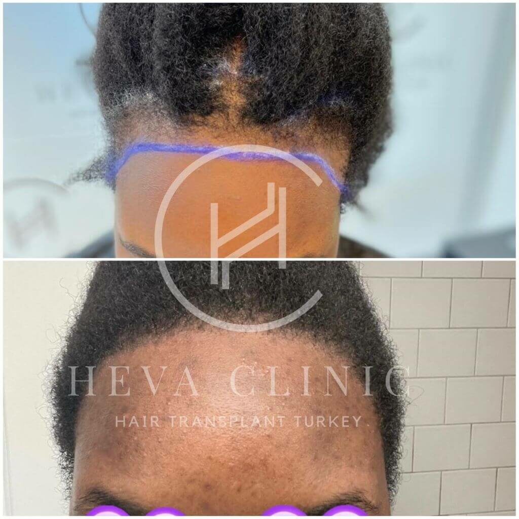 Frontline afro woman before after hair transplant