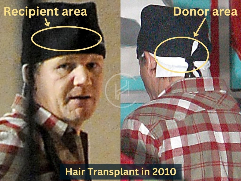 Gordon ramsay after hair transplant in 2010