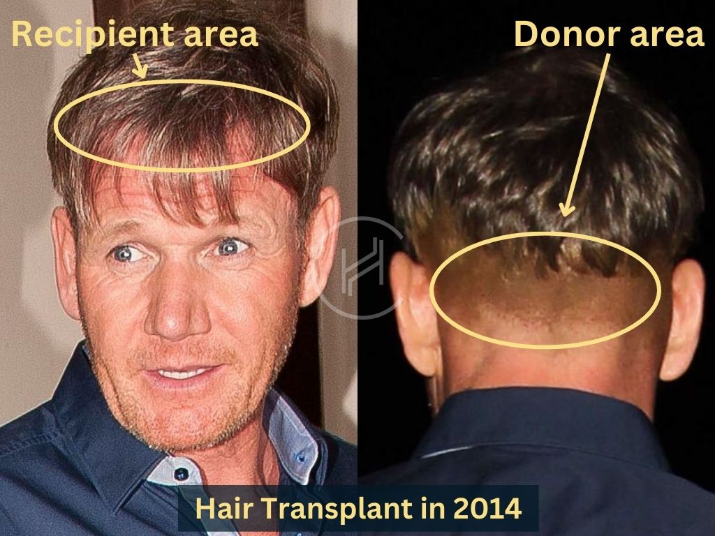 Gordon ramsay after hair transplant operation in 2014