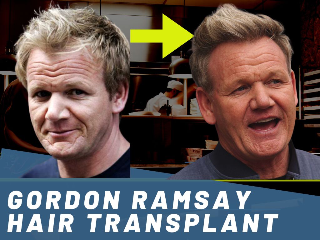 Gordon ramsay hair transplant analysis banner