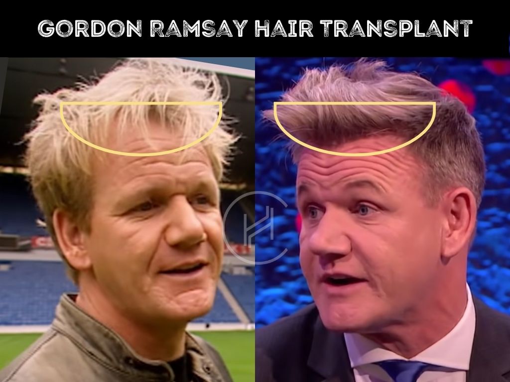 Gordon ramsay hair transplant before and after