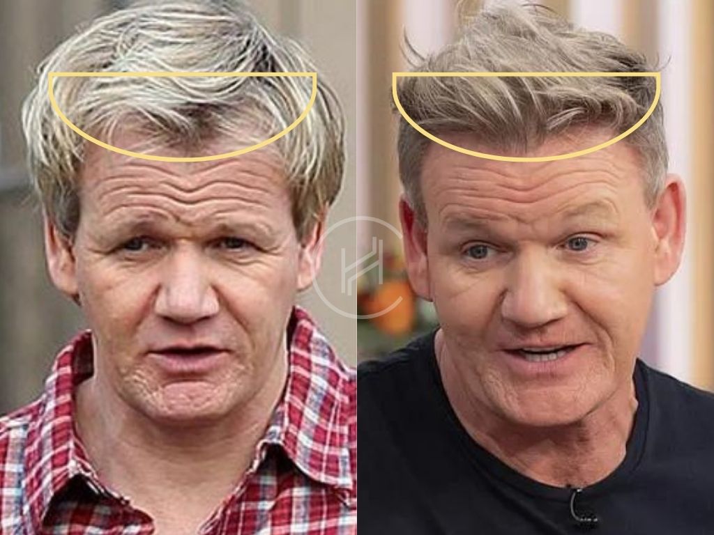 Gordon ramsay hair transplant result before and after frontline