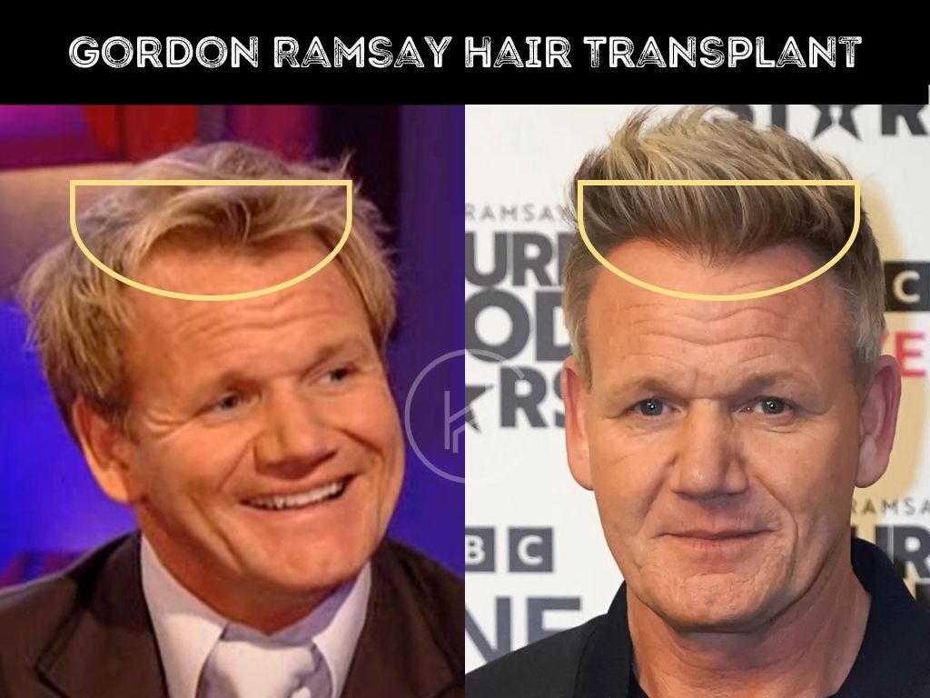 Gordon ramsay hair transplant