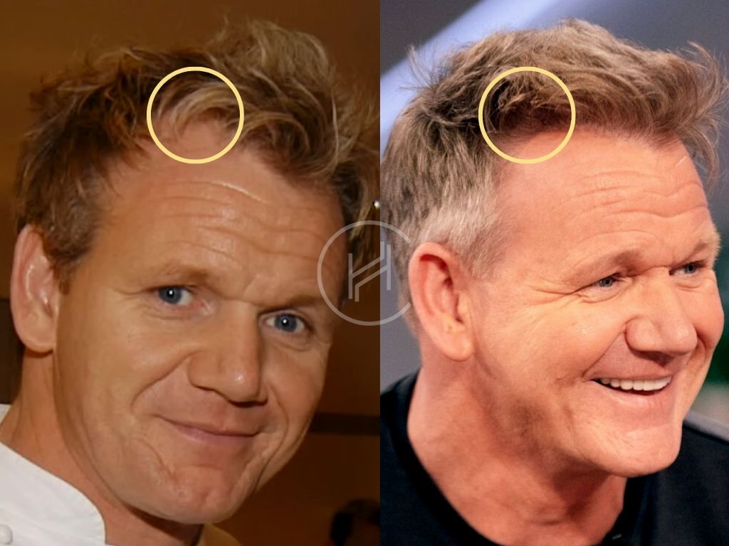 Gordon ramsay hairline hair transplant before and after