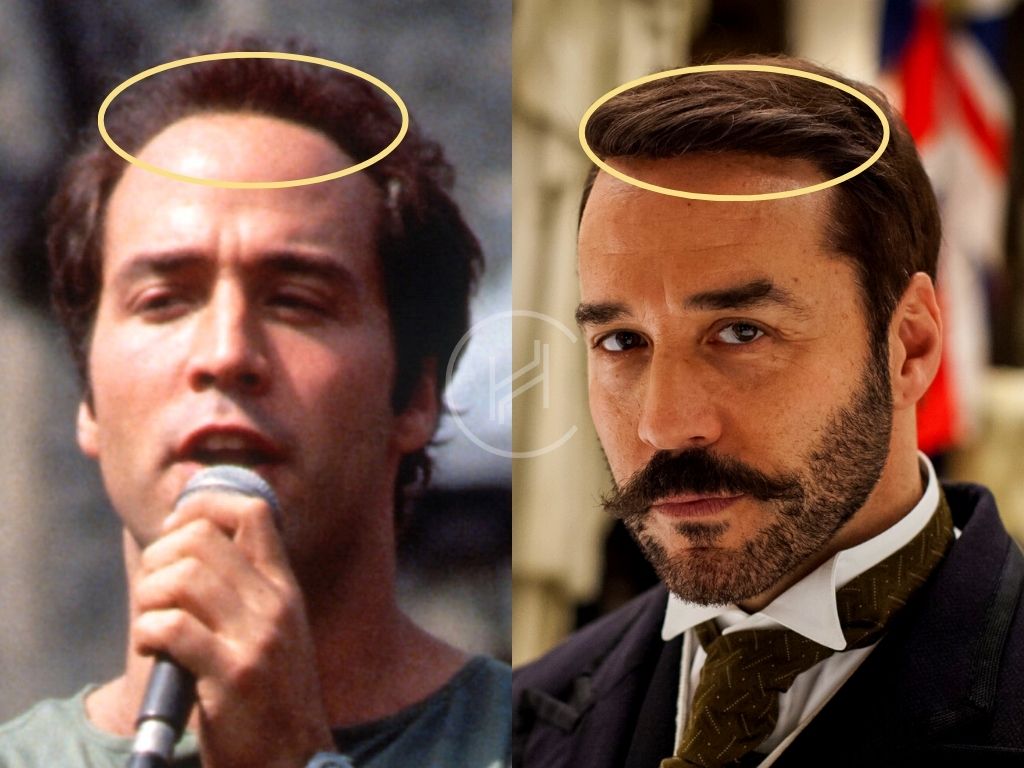 Hair Transplant Before & After Jeremy Piven