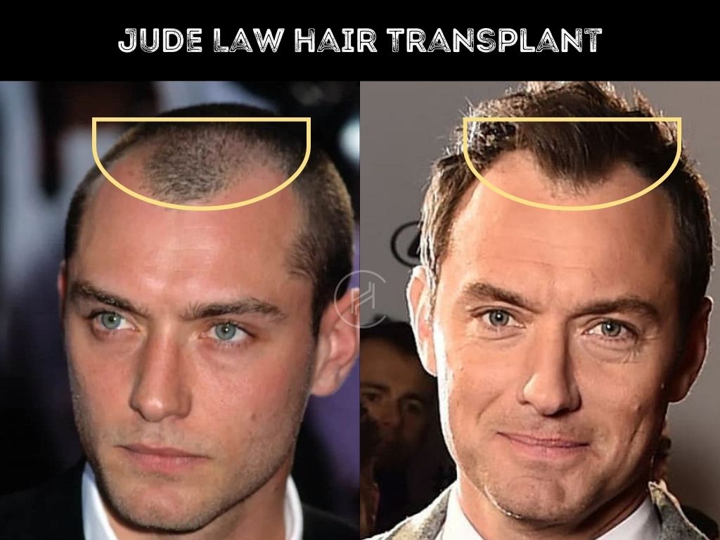 Hair Transplant Before and After Jude Law