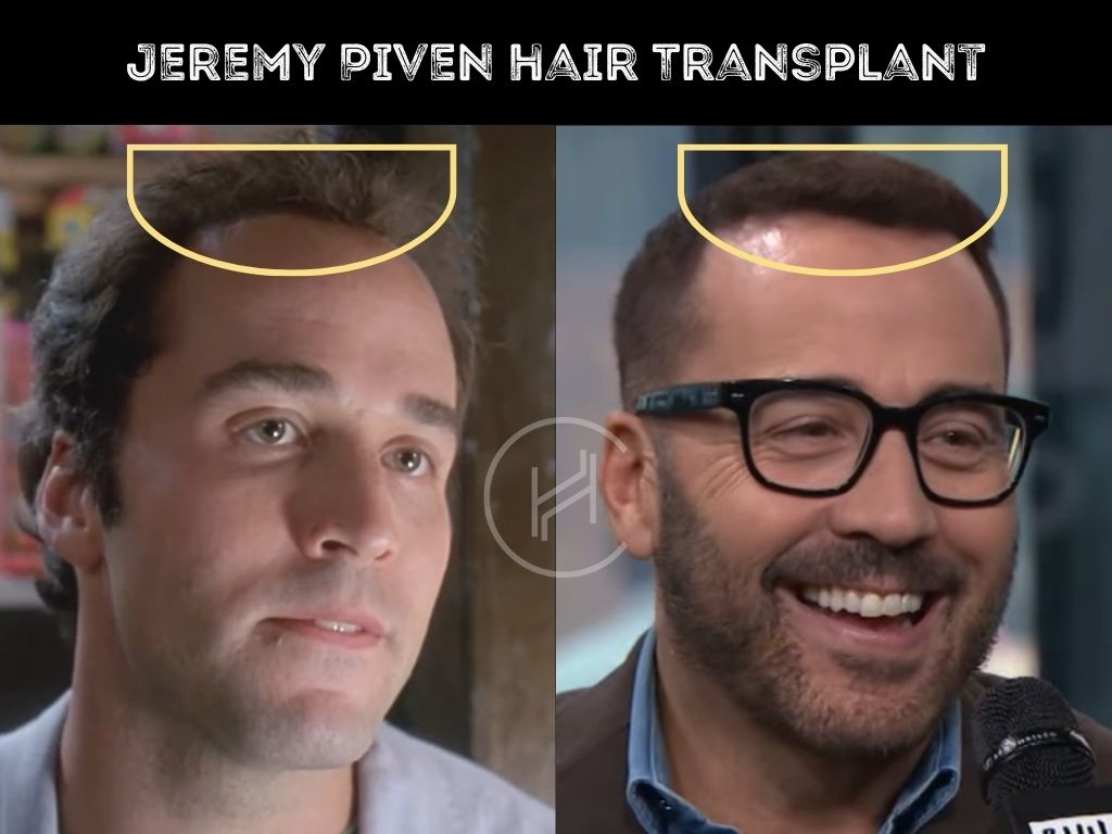 Jeremy Piven Celebrity Hair Transplant Before and After