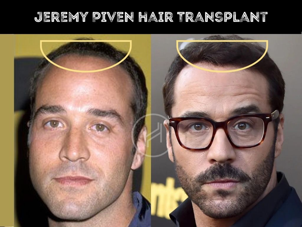 Jeremy Piven Hair Transplant Before and After