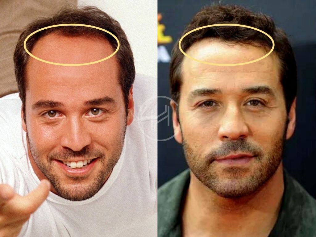 Jeremy Piven Hair Transplant Result Before and After