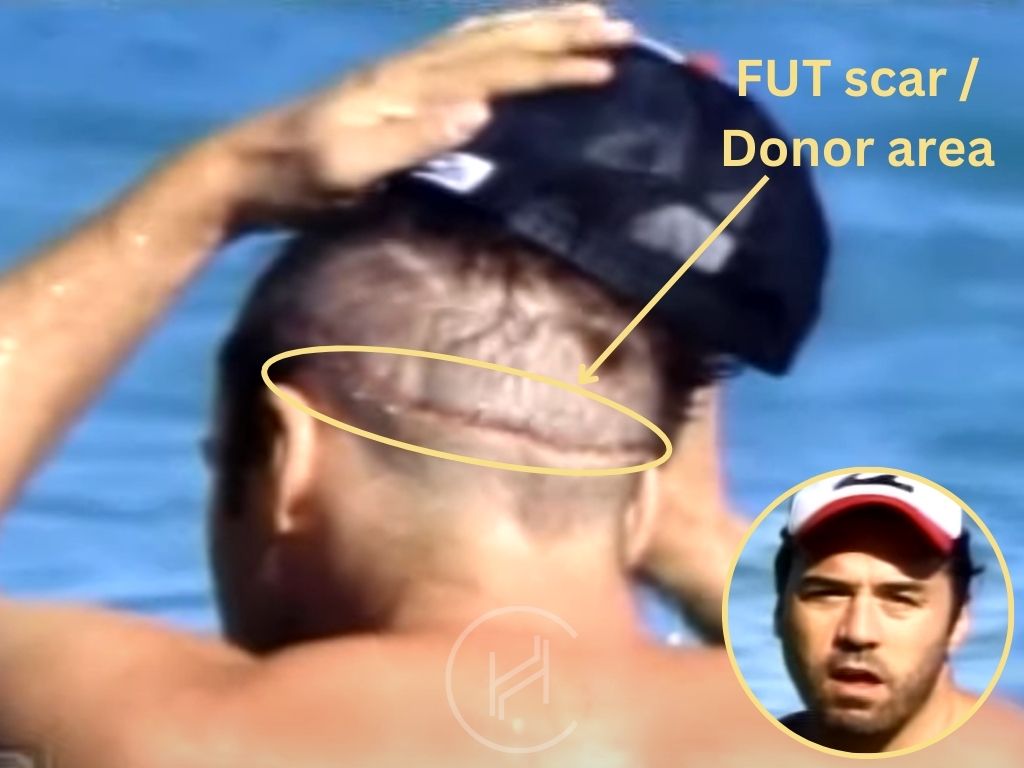 Jeremy Piven hair transplant fut scar