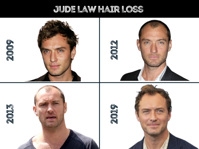 Jude Law Hair Loss