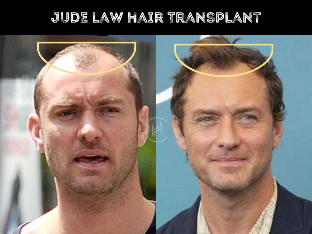 Jude Law Hair Transplant Before and After Hairline