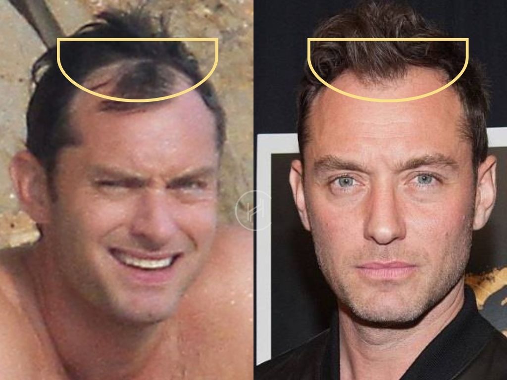 Jude Law Hair Transplant Before and After Result