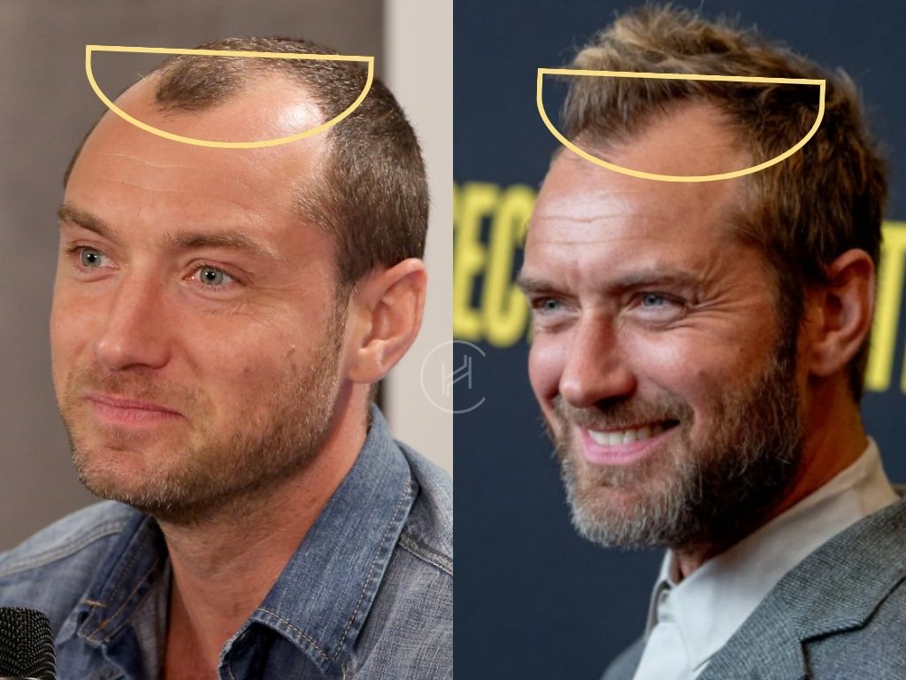 Jude Law Hair Transplant Before and After Transformation