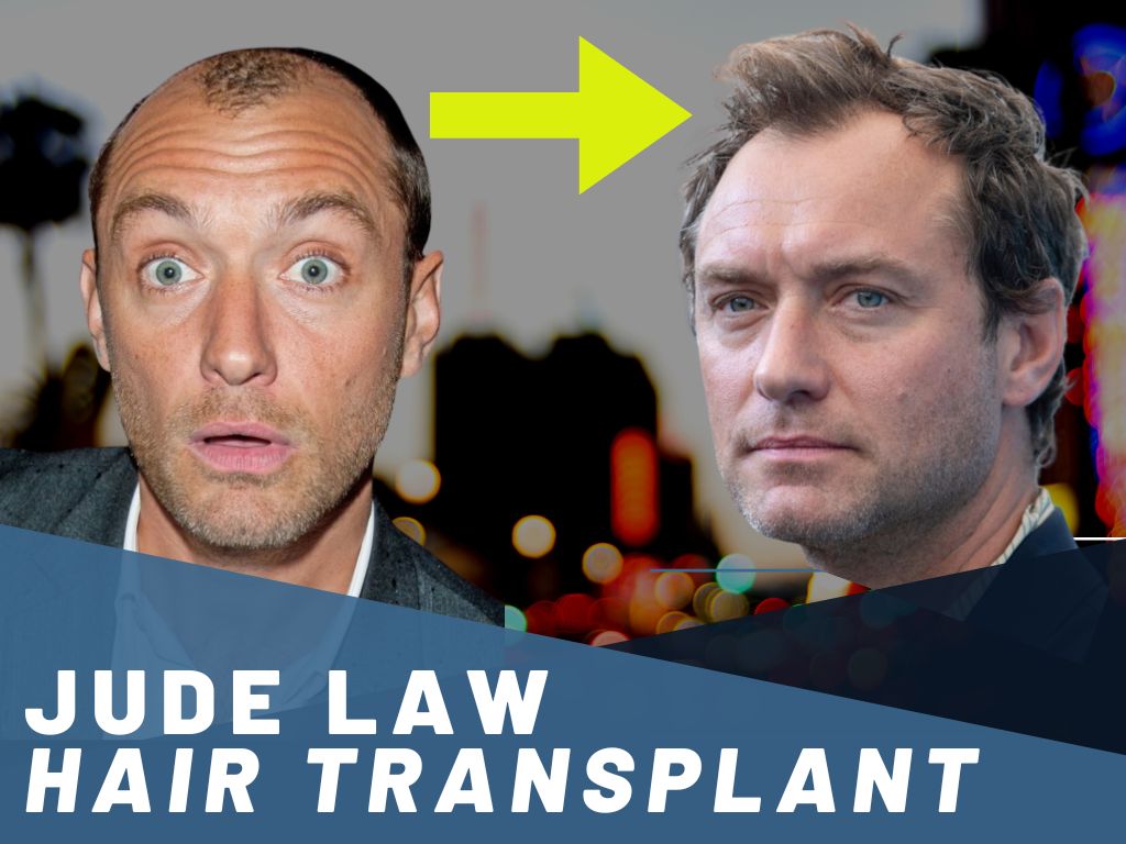 Jude Law Hair Transplant  