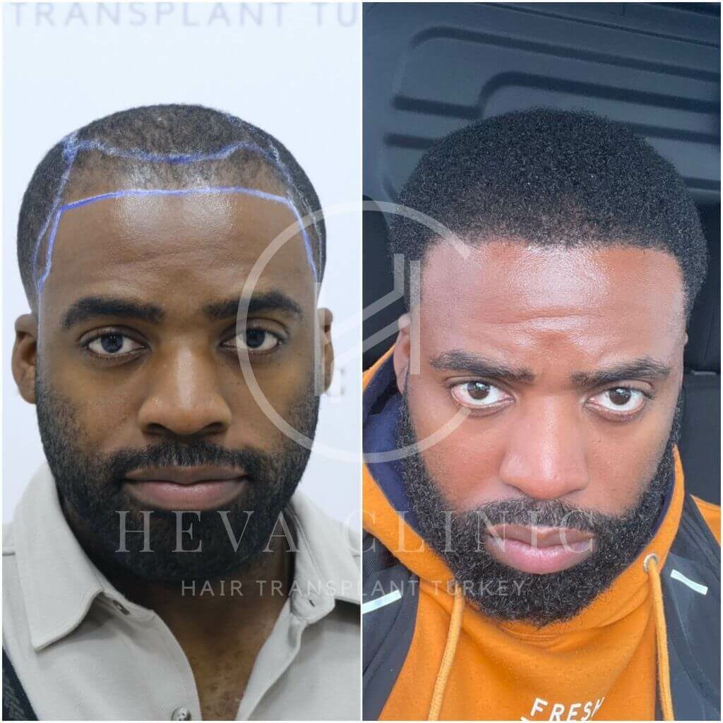 Norwood 3 afro textured hair transplant before and after