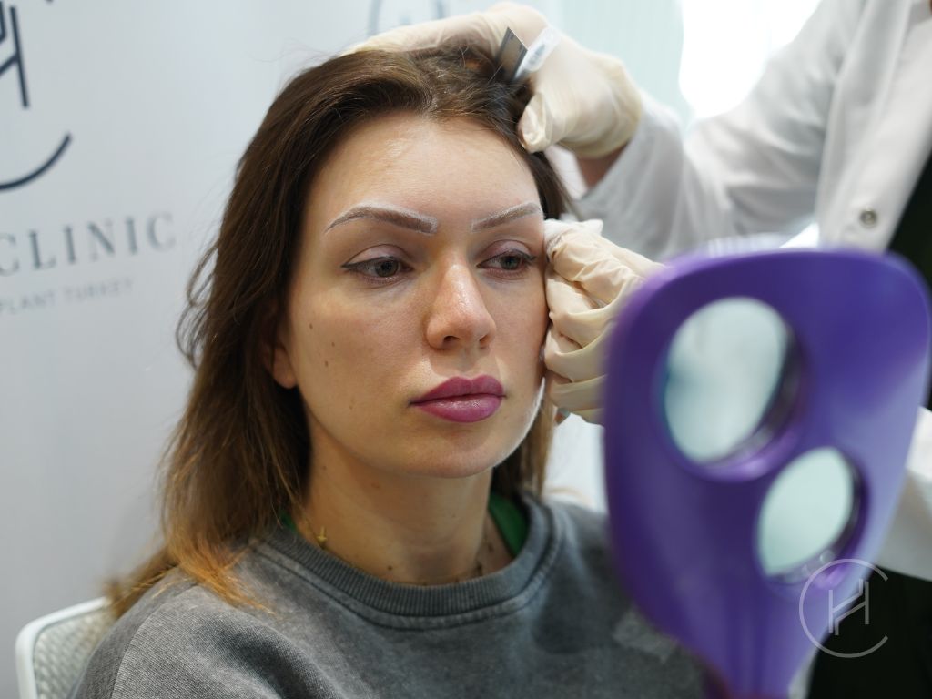 PCOS Hair Loss Treatment and Hair Transplant Best Solutions For