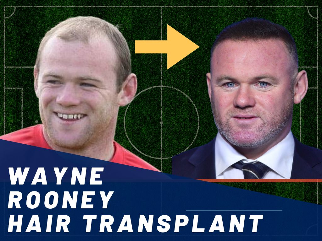 Wayne Rooney Hair Transplant - Hair Loss & Technical Analysis