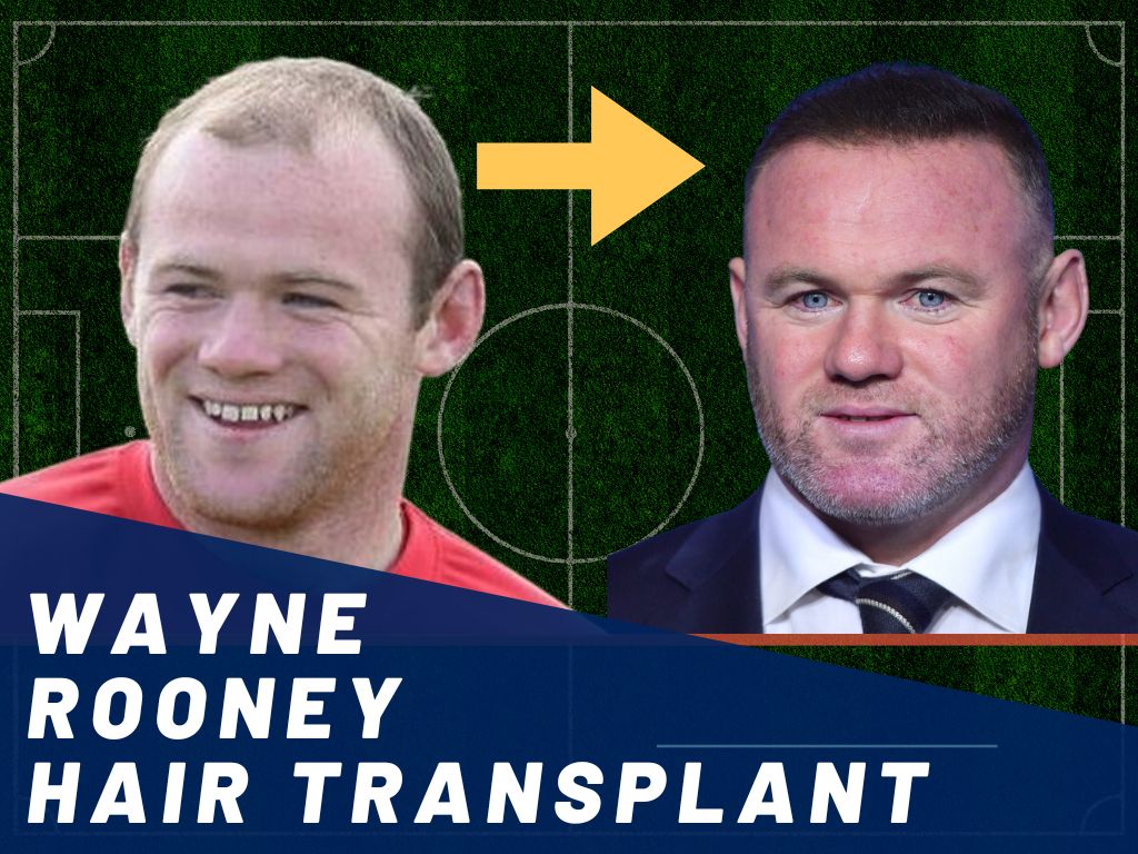 Wayne Rooney Hair Transplant  Hair Loss  Technical Analysis