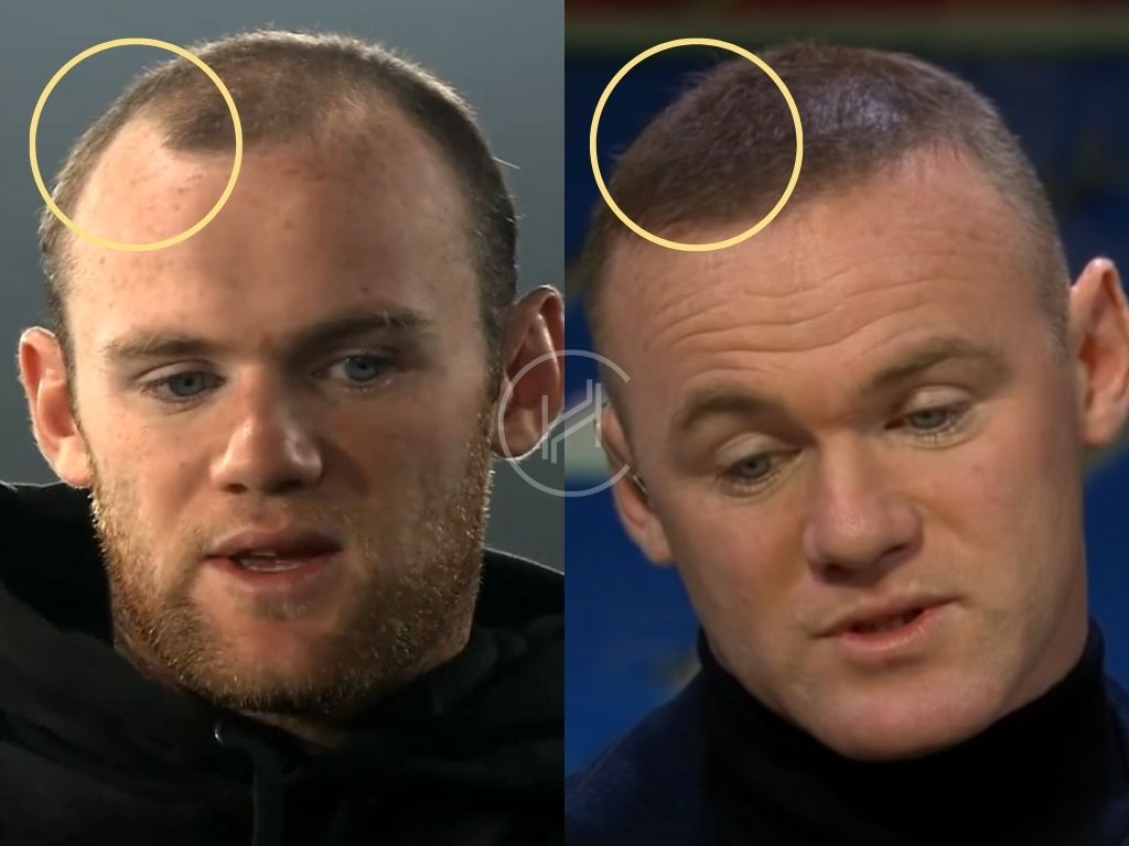 Wayne Rooney hair transplant before and after temple area result