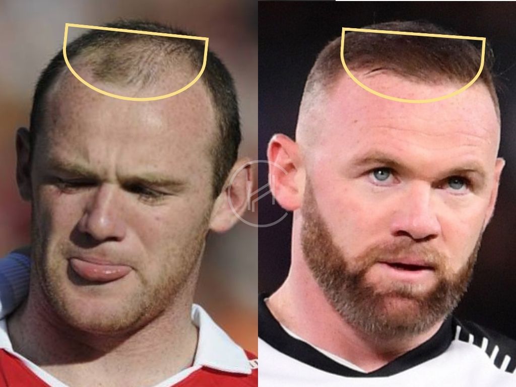 Wayne Rooney hair transplant before and after