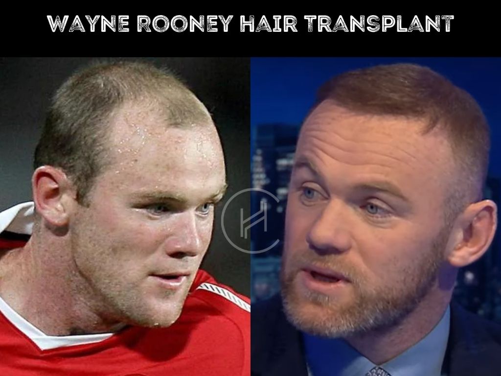 Wayne Rooney hair transplant difference before and after