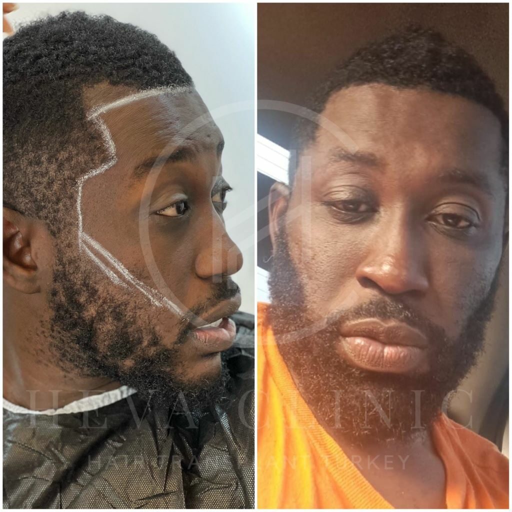 afro beard transplant before and after photo