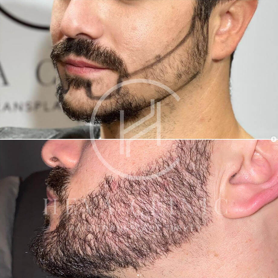 beard transplant closeup photo before and after