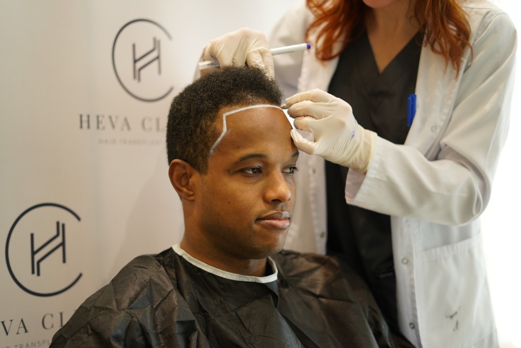 9 Things To Do Before Hair Transplant Surgery - Heva Clinic